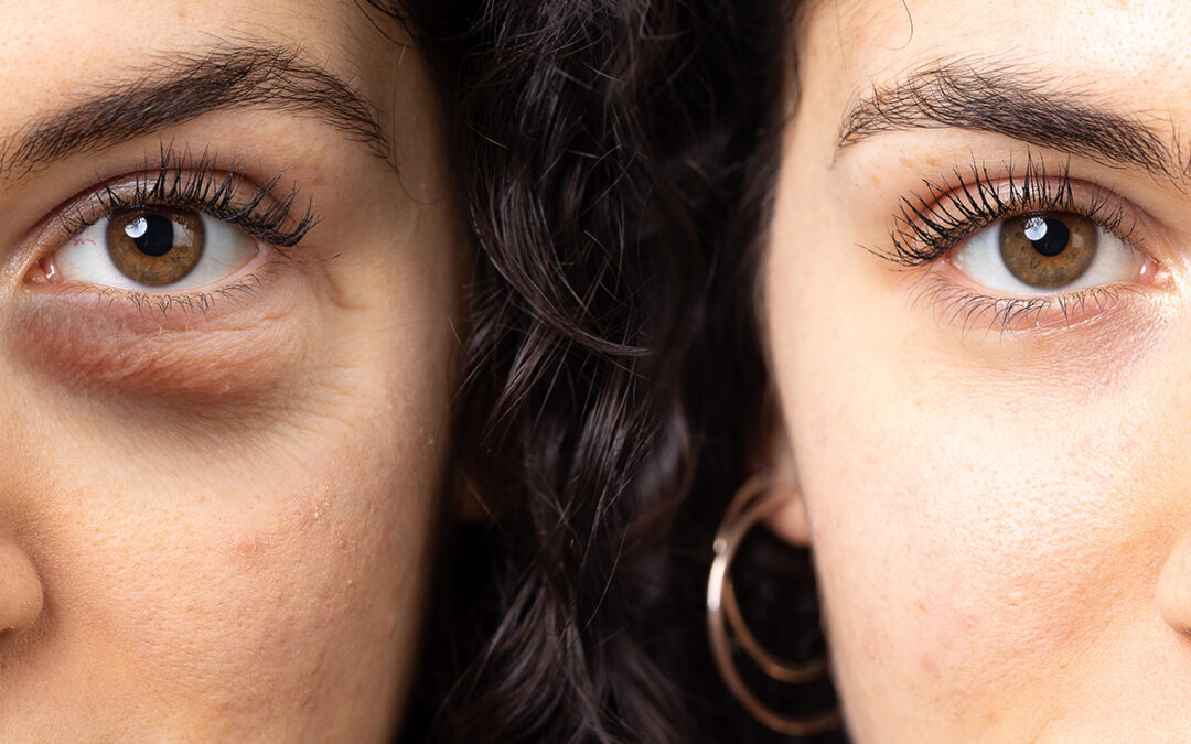 What is Blepharoplasty?