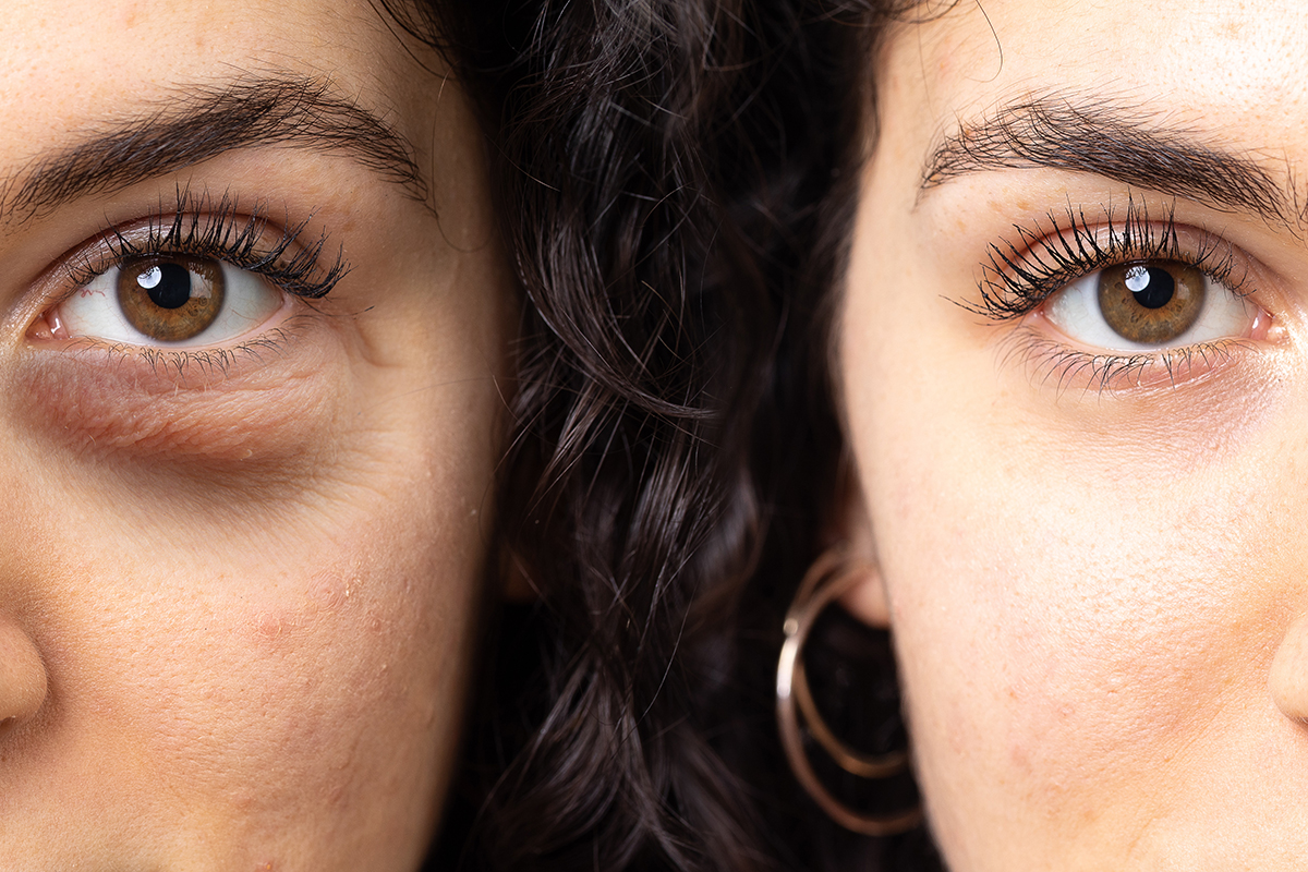 Skincare face skin blemishes side by side comparison