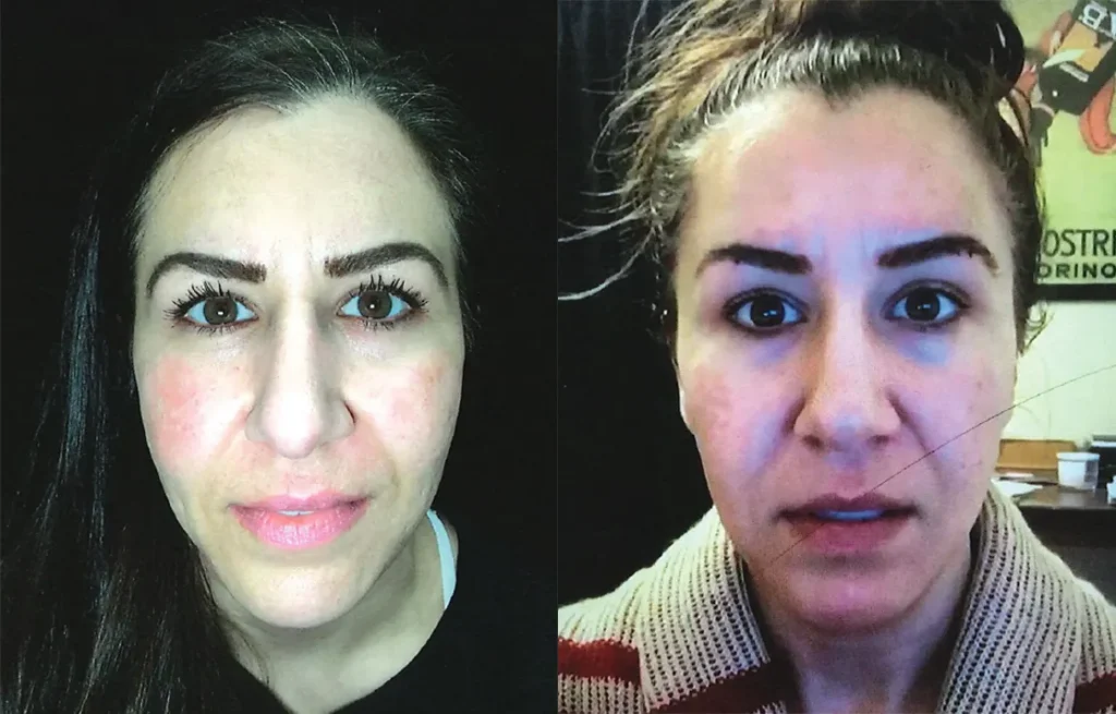 Front View Novathreads Before and After photo by AMARA Medical Aesthetics