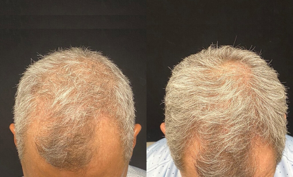 PRP Hair Restoration Before and After photo by AMARA Medical Aesthetics in Bellevue, WA