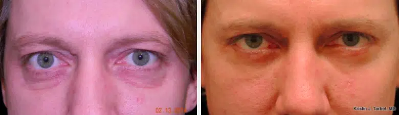 brow lift before after brow lift before after