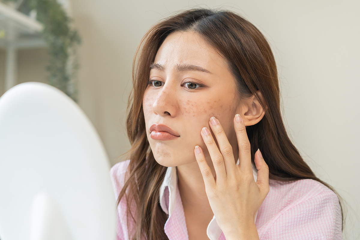 Stressed Asian young woman hand touching facial at dark spot of melasma