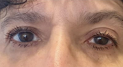 Upneeq Before and After photo by AMARA Medical Aesthetics in Bellevue WA