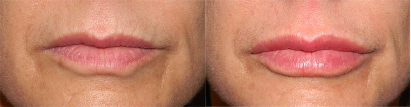 Injectables Lip Filler Before and After photo by AMARA Medical Aesthetics in Bellevue WA