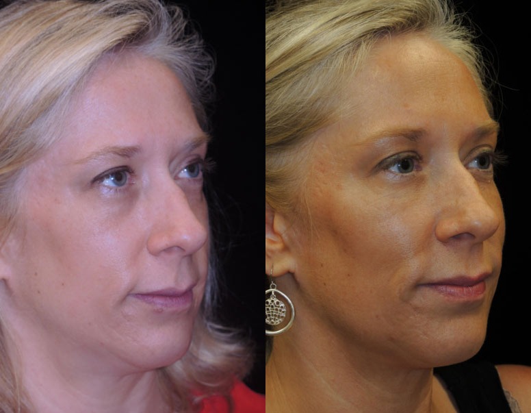 Injectables Voluma Before and After photo by AMARA Medical Aesthetics in Bellevue WA