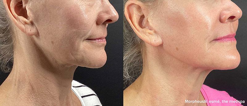 Morpheus Before and After photo by AMARA Medical Aesthetics in Bellevue WA