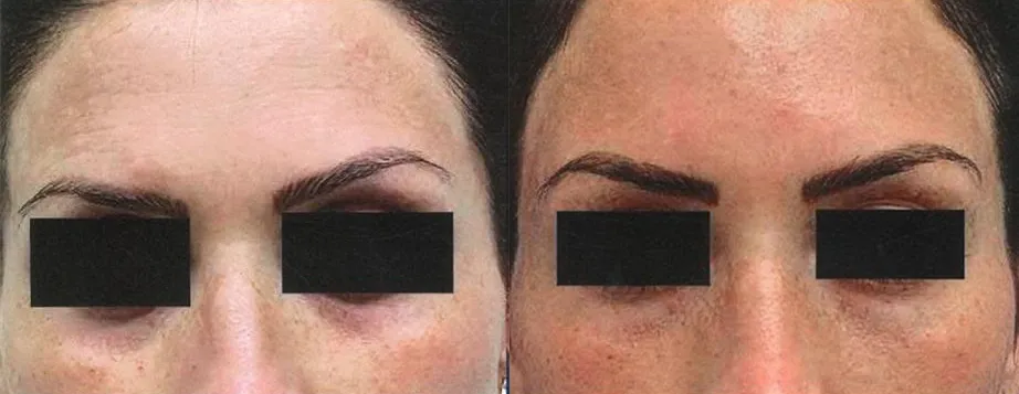 Front View PRP Injectable Before and After photo by AMARA Medical Aesthetics
